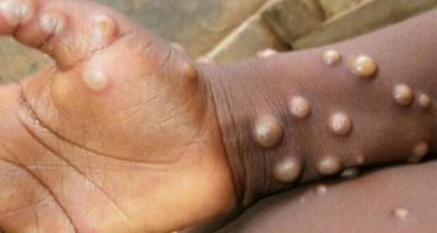 DEU NEGATIVO: Guaxupeana de 51 anos não está com varíola do macaco