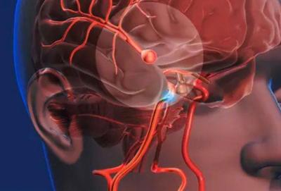 Aneurisma cerebral ainda mata um em cada cinco pacientes no Brasil, mas tcnica moderna reduz riscos
